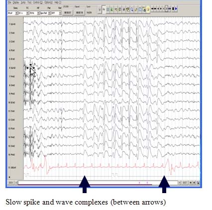 graph of EEG
